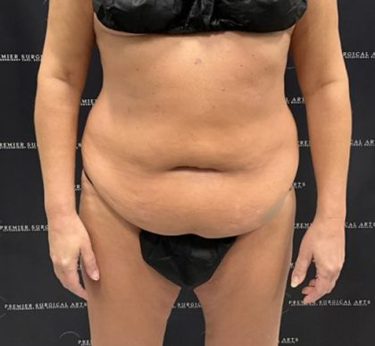 Tummy Tuck Before & After Patient #2212