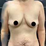 Breast Augmentation Before & After Patient #2236