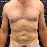 Liposuction Before & After Patient #2181