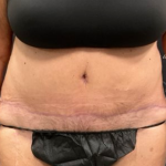Tummy Tuck Before & After Patient #2193