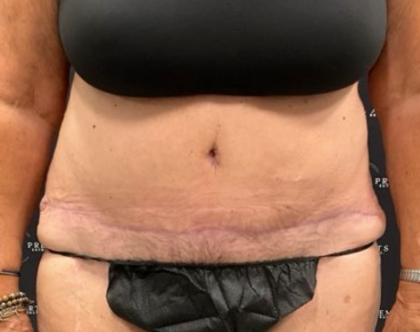 Tummy Tuck Before & After Patient #2193