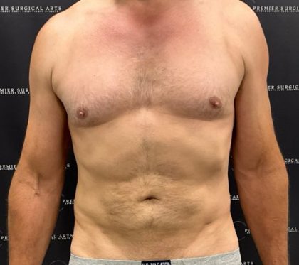 Liposuction Before & After Patient #2181