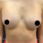 Breast Augmentation Before & After Patient #2198
