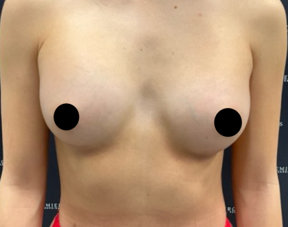 Breast Augmentation Before & After Patient #2198