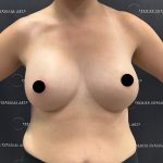 Breast Augmentation Before & After Patient #2203