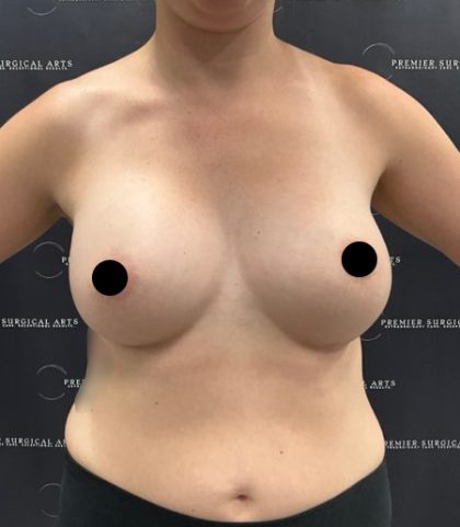 Breast Augmentation Before & After Patient #2203