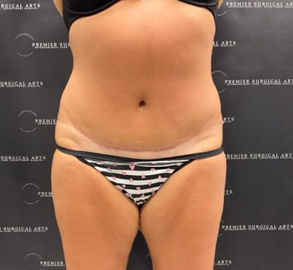 Tummy Tuck Before & After Patient #2212