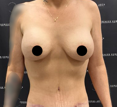 Breast Augmentation Before & After Patient #2236