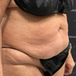 Tummy Tuck Before & After Patient #2193