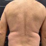 Liposuction Before & After Patient #2181