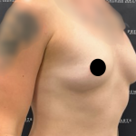 Breast Augmentation Before & After Patient #2163