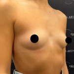 Breast Augmentation Before & After Patient #2198