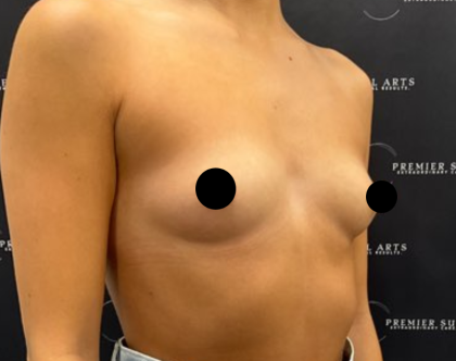 Breast Augmentation Before & After Patient #2198