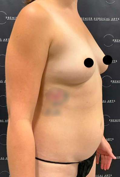 Breast Augmentation Before & After Patient #2203