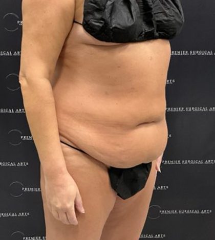 Tummy Tuck Before & After Patient #2212
