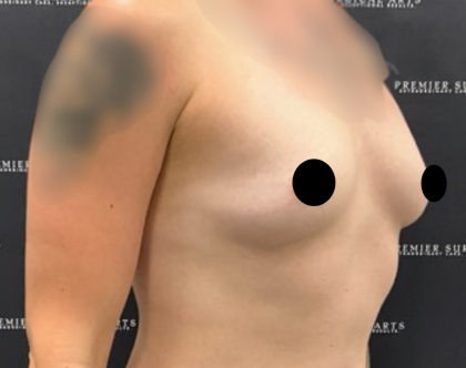 Breast Augmentation Before & After Patient #2163