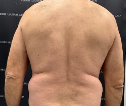 Liposuction Before & After Patient #2181