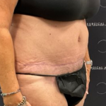 Tummy Tuck Before & After Patient #2193