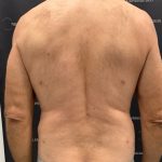 Liposuction Before & After Patient #2181