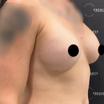 Breast Augmentation Before & After Patient #2163