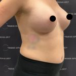 Breast Augmentation Before & After Patient #2203