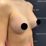 Breast Augmentation Before & After Patient #2198