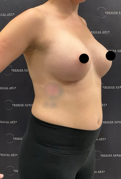 Breast Augmentation Before & After Patient #2203