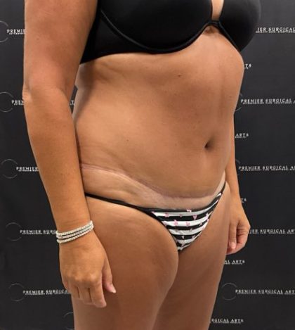 Tummy Tuck Before & After Patient #2212
