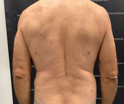 Liposuction Before & After Patient #2181