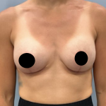Breast Augmentation + Lift Before & After Patient #2168
