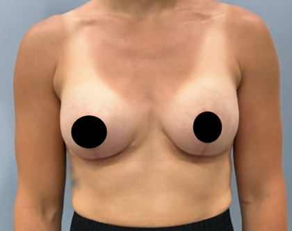 Breast Augmentation + Lift Before & After Patient #2168
