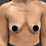 Breast Augmentation + Lift Before & After Patient #2168