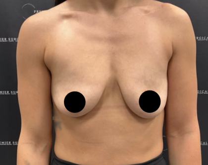Breast Augmentation + Lift Before & After Patient #2168