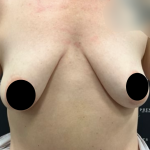 Breast Augmentation + Lift Before & After Patient #2259