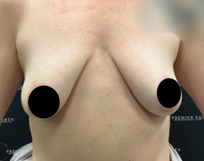 Breast Augmentation + Lift Before & After Patient #2259