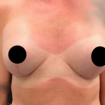 Breast Augmentation + Lift Before & After Patient #2259