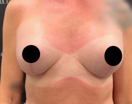Breast Augmentation + Lift Before & After Patient #2259