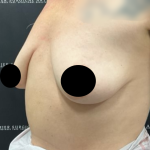 Breast Augmentation + Lift Before & After Patient #2259