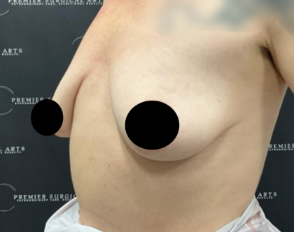 Breast Augmentation + Lift Before & After Patient #2259