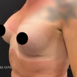 Breast Augmentation + Lift Before & After Patient #2259