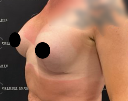 Breast Augmentation + Lift Before & After Patient #2259