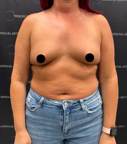 Breast Augmentation Before & After Patient #2173