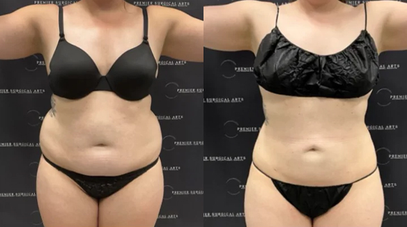 before after