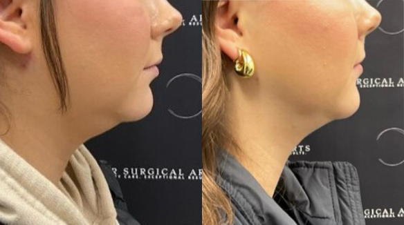 before after