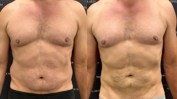 before after