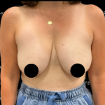 Breast Lift Before & After Patient #2315