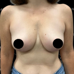 Breast Lift Before & After Patient #2315