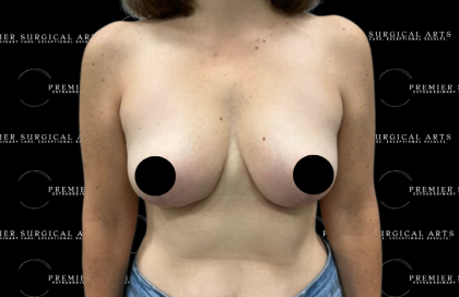 Breast Lift Before & After Patient #2315
