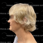 Neck Lift Before & After Patient #2323