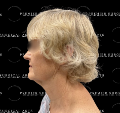 Neck Lift Before & After Patient #2323